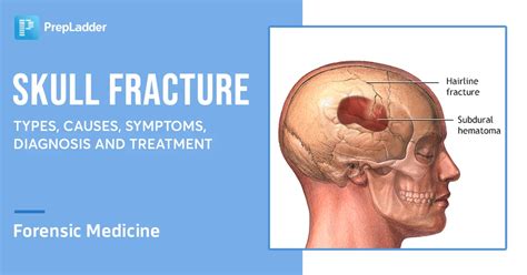 Skull Fracture: Types, Causes, Symptoms, Diagnosis And Treatment