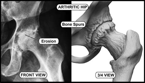 X-ray and illustration of degenerated hip joint where arthritis – Hip ...