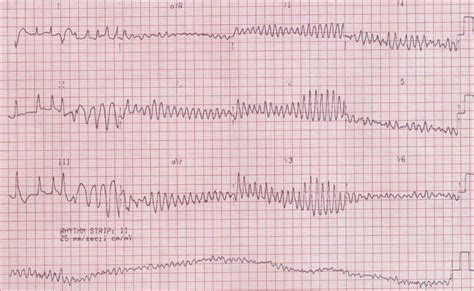 Ventricular Fibrillation - Cardiovascular - Medbullets Step 2/3