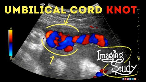 False Knot Umbilical Cord