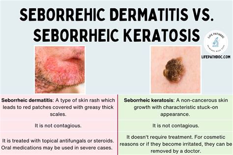 Seborrheic Dermatitis vs. Seborrheic Keratosis (with Pictures)