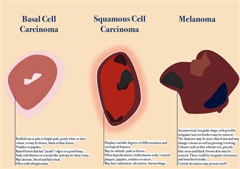 Main Type of Skin Cancer — Their Differences, Histology and Prevention ...