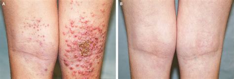 Eczema Herpeticum | NEJM