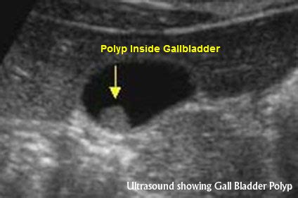 Gallbladder polyps – Symptoms, Diagnosis and Risks