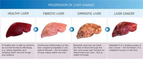 liver disease rash - pictures, photos