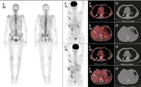 FDG-PET/CT is accurate in diagnosing breast cancer recurrence – Atlas ...