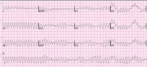 Dr. Smith's ECG Blog: Ventricular fibrillation on a 12-lead ECG