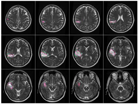 Brain Mri Scan Tumor