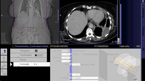 CT Scan of Chest with contrast full work " SEIMENS" - YouTube