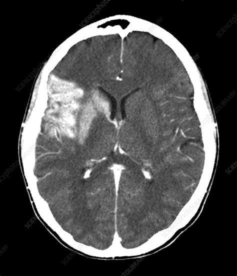 Stroke, CT brain scan - Stock Image M136/0288 - Science Photo Library