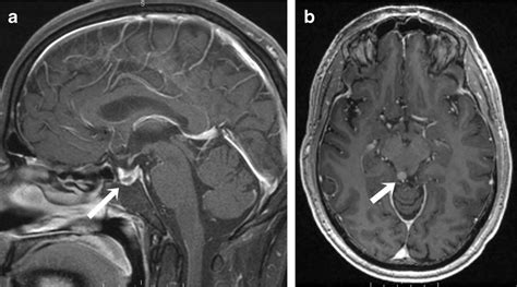 Pituitary Gland Mri Sagittal