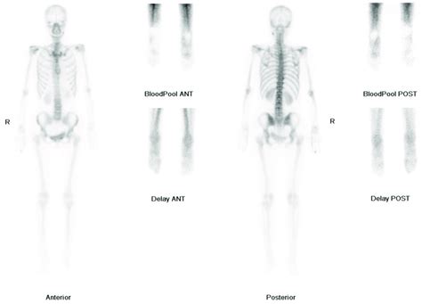 Three-phase bone scan: Decreased uptake in the right foot during the ...