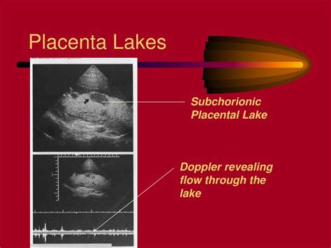 PPT - Bleeding Late in Pregnancy PowerPoint Presentation, free download ...