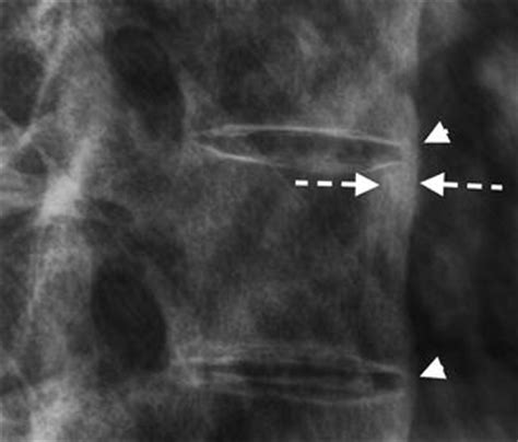 Spondyloarthropathy | Radiology Key