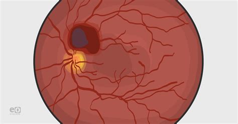 Valsalva Retinopathy: From Diagnosis to Intervention