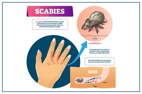 Scabies: Symptoms, Causes, Prevention, & Treatment