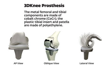 Total Knee Replacement Implants - Prostheses, Artificial Prosthesis