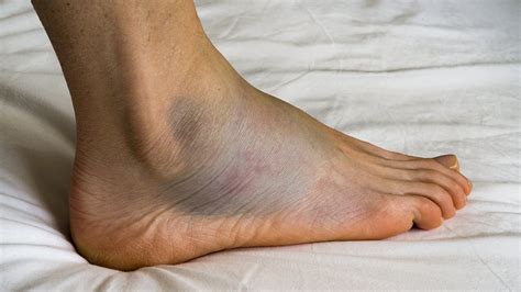 Are Swollen Feet A Sign Of Heart Failure?, 60% OFF