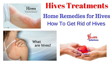 How to treat hives - Hives Treatments - Home Remedies for Hives - YouTube