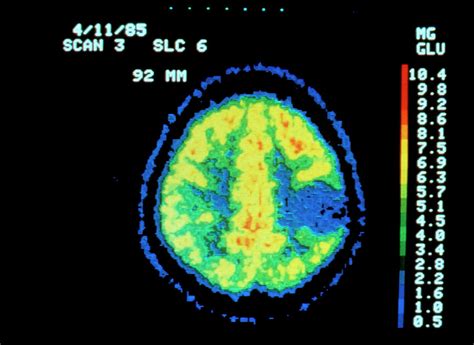 Coloured Pet Scan Of The Brain Showing A Tumour Photograph by National ...