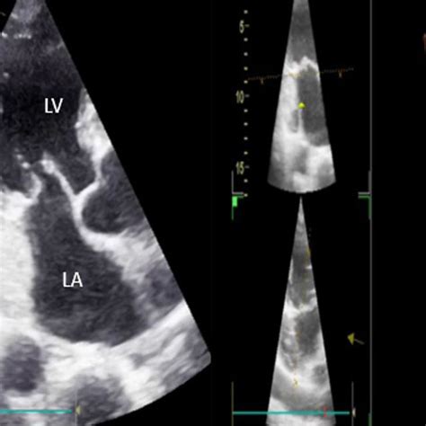 Persistent left superior vena cava on 2D and 4D echocardiography after ...