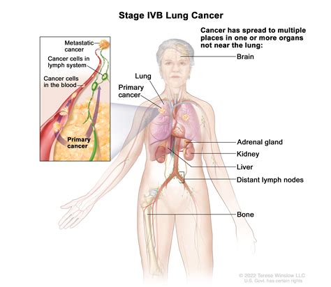 Lung Cancer Cells Diagram