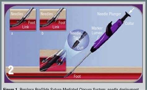 Figure 3 from Femoral artery closure after cardiac catheterization ...