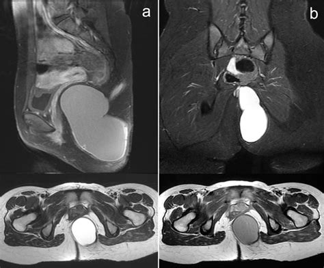 Pelvic MRI: (a) Giant, retrorectal epidermoid cyst, (b) pilonidal ...