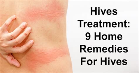 Hives Treatment: 9 Home Remedies For Hives - David Avocado Wolfe