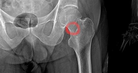 Distal Femur Stress Fracture