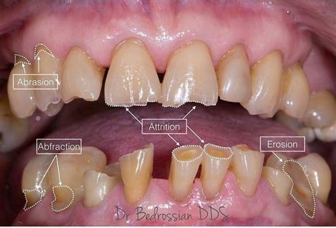 Difference between dental attrition, abfraction, erosion and abrasion ...