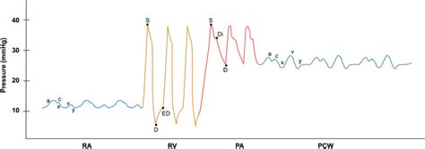 Pulmonary Artery Catheter Waveforms