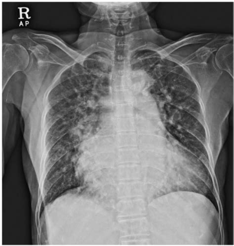 Chest X-ray showing cardiomegaly and pulmonary congesti | Open-i