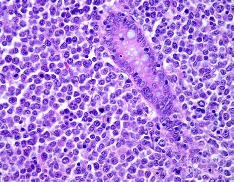 Diffuse Large B-cell Lymphoma Photograph by Webpathology/science Photo ...