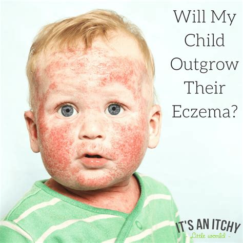 "Will your child outgrow their eczema?" A dermatologist's perspective ...