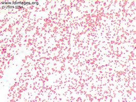 Neisseria Gonorrhoeae Gram Stain : Neisseria gonorrhoeae in urethral ...