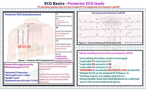 ECG Educator Blog : 02/10/16