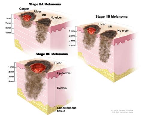 Melanoma Skin Cancer Stages