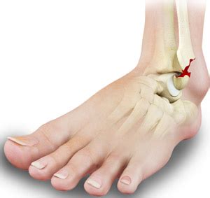 Stress Fracture Of The Foot Atlanta GA | Stress Fracture Of The Ankle ...