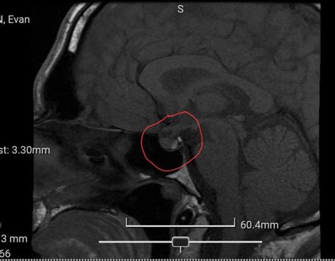 Surgery : r/Prolactinoma