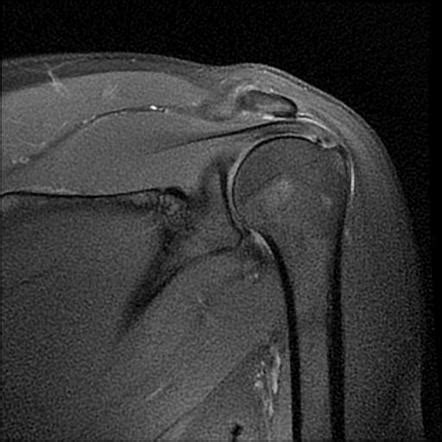 Supraspinatus Tear Mri