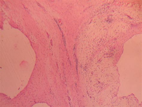 MENISCAL CYST – Histopathology.guru