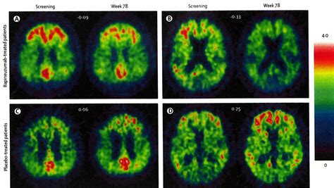 Amyloid PET Identifies Those At Risk For Alzheimer’s Disease – Center ...