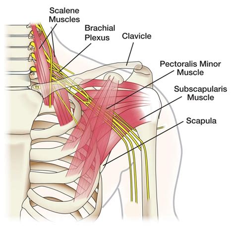 Brachial Plexus Injury Football