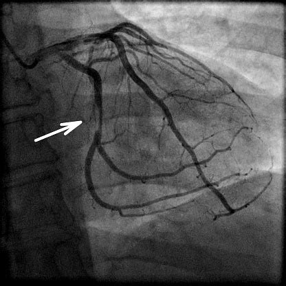 Coronary Artery Stenosis On Angiography Stock Photo - Download Image ...