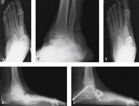 Triple Arthrodesis | Plastic Surgery Key