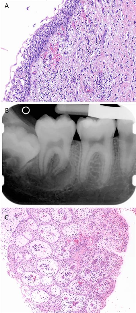 Residual Cyst Histology