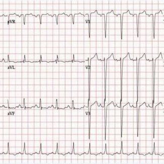 ECG showing sinus tachycardia, left atrial enlargement, T wave ...