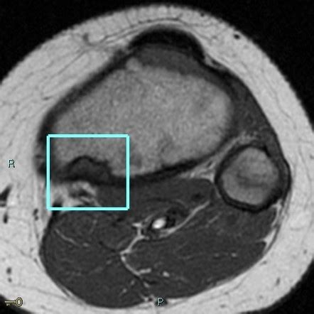 Fibrous cortical defect | Radiology Case | Radiopaedia.org