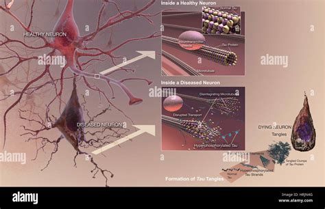 Alzheimer's Disease, Neurofibrillary Tangles Stock Photo - Alamy